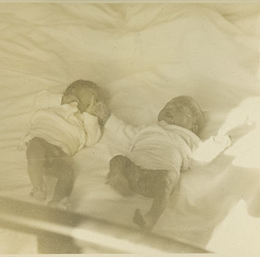 Small newborn twins lying in a bed, legs visible.